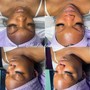 Microdermabrasion