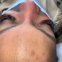 Dermaplaning