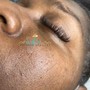 Hyperpigmentation/Dark Marks Chemical peel