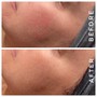 DERMALPLANING + MICRODERMABRASION COMBO FACIAL