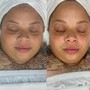 Acne Clarifying Facial w/ LED