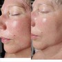 Face Reality Acne Facial