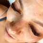 Glycolic Peel