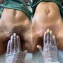 Buttocks Hair Removal