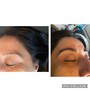 Chemical peel