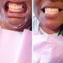 Teeth Whitening