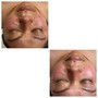 "BACK FACIAL " Treatment