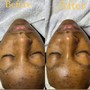 Acne Facial