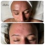 Acne Corrective Facial & Peel