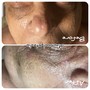 Hyperpigmentation Facial