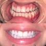 Advanced Teeth Whitening