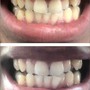 Advanced Teeth Whitening