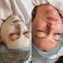 Microdermabrasion