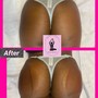 Butt Enhancment Vaccum therapy /Cupping