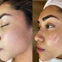 Facial Dermaplaning