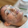 Acne/Deep Pore Cleansing Facial