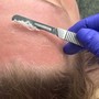 Brow permanent makeup Removal