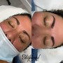 RF Skin Tightening