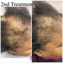 Scalp Treatment Services