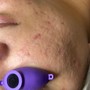 MicroNeedling