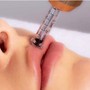 MicroNeedling