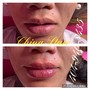 Lips Hyaluron Pen (Needle-less Lip Injections)