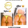 Butt and Hip Enhancement