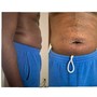 1 session Laser lipo/cavitation