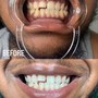 BB Upper/Lower Lip Package