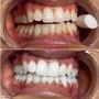 Teeth Whitening