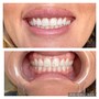 Teeth Whitening