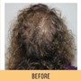 Keravive Scalp Exfoliating Treatment for Thinning Hair