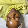 Microdermabrasion facial