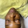 Acne Facial