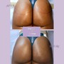 Goddess body Butt Enhancement and Waist Contouring(SINGLE SESSION ONLY)