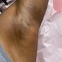 Leg Sugaring