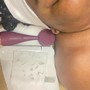 Microdermabrasion