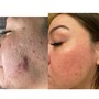 KP Microneedling+Peel Arms