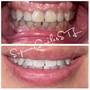 NEW Teeth Whitening Club!