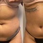 Laser Lipo Only- One Area