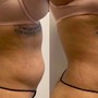 Laser Lipo Only- One Area