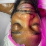 Peach Facial (Buttocks)