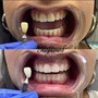 Teeth Whitening