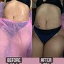 60 minute ultrasonic cavitation -6 sessions