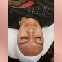 Chemical peel