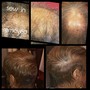 Scalp Treatment