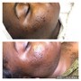 Mole/Skintag removal and consultation