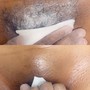 Beard Treatment and Dermaplane