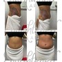 RF Skin Tightening