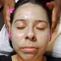 Chemical peel